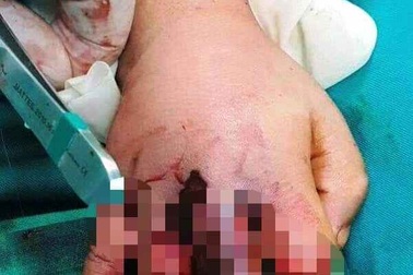 Bé trai 4 tuổi bị dập nát đốt tay vì kẹt tay vào máy ép mía