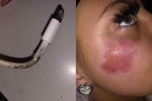 Thiếu nữ bị bỏng mặt vì iPhone bất ngờ phát nổ khi cắm sạc qua đêm