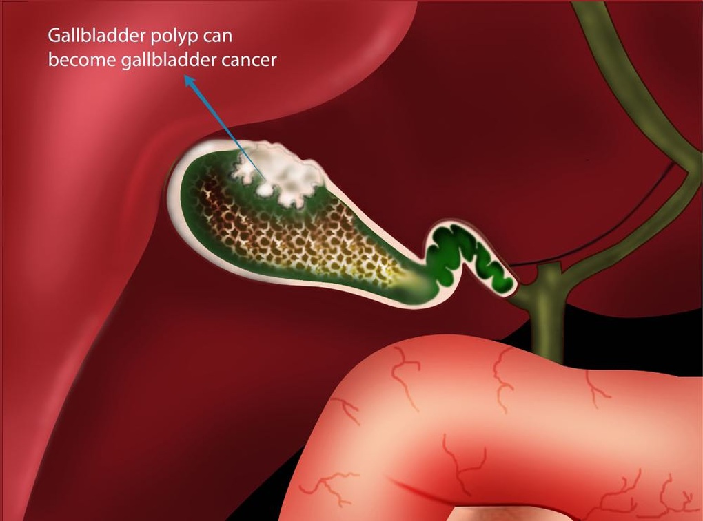 Polyp túi mật có phải là ung thư không? - 1 Polyp túi mật có phải là ung thư không? - 1
