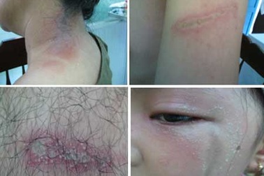 80% bác sĩ nhầm lẫn giữa viêm da tiếp xúc do côn trùng và zona