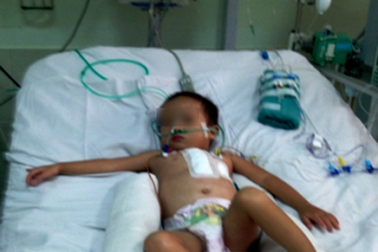 Cứu sống bệnh nhi nguy kịch sau phẫu thuật tim lần 2