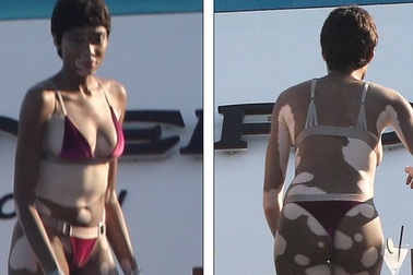 Thân hình loang lổ, người mẫu Canada vẫn tự tin diện áo tắm