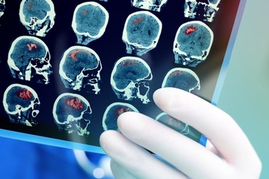 Giật mình vì cách sơ cứu đột quỵ bằng chích máu ở tai, đầu ngón tay