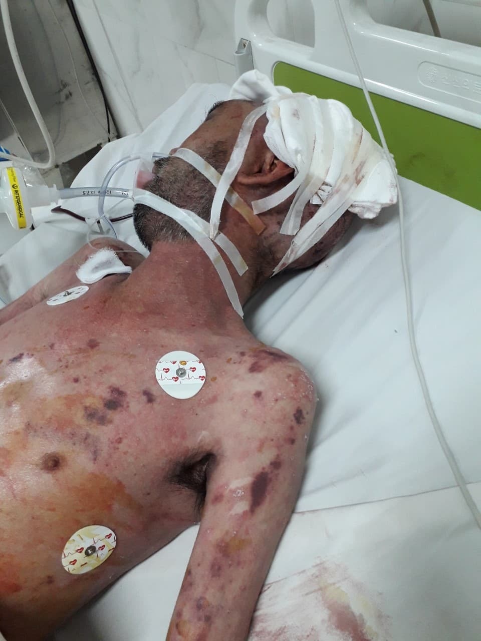 Nỗi khổ đau chồng chất của người đàn ông không dám cựa mình vì da nứt toác - 5 Nỗi khổ đau chồng chất của người đàn ông không dám cựa mình vì da nứt toác - 5