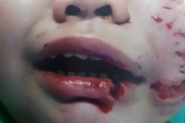 3 cháu bé bị kẻ ngáo đá chém trọng thương, phơi nhiễm HIV