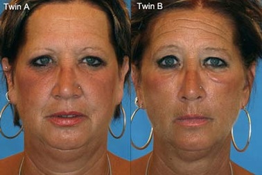 Những tổn thương da do hút thuốc lá