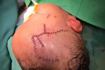 Nghệ An: Kinh hãi bé trai 2 tuổi bị chó cắn lộ cả xương sọ