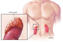 Dấu hiệu ung thư tuyến thượng thận