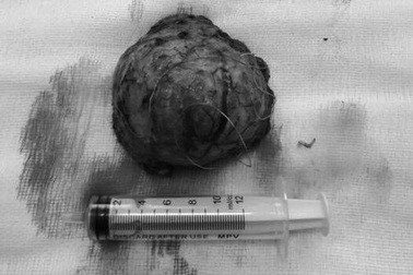 Lấy thành công khối u to quả bóng tennis trong trán