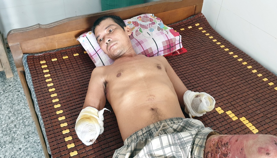 Xót xa người đàn ông đi kiếm cơm nuôi con bị phóng điện mất đôi bàn tay - 3 Xót xa người đàn ông đi kiếm cơm nuôi con bị phóng điện mất đôi bàn tay - 3