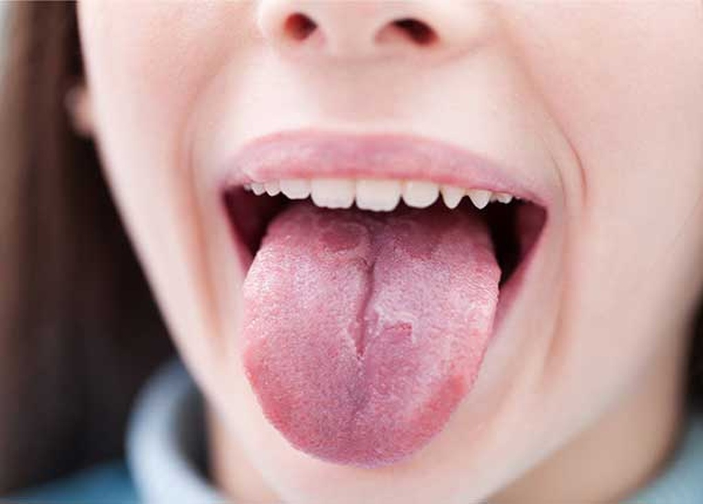 Điều trị ung thư lưỡi như thế nào? - 1 Điều trị ung thư lưỡi như thế nào? - 1