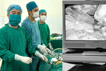 Mua thuốc trên mạng để uống, người phụ nữ thủng ruột nguy kịch