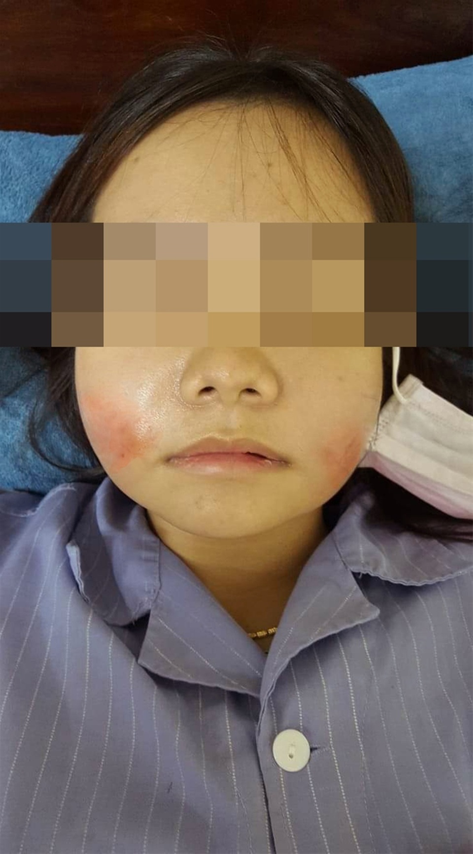 Má đỏ rực như hai quả cà chua sau khi tiêm filler giảm nếp nhăn tại spa - 1