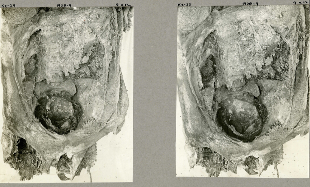 Ảnh chụp tại hiện trường khai quật vào năm 1908 cho thấy bụng của xác ướp bị rạch và đầu của thai nhi nằm trong khoang chậu. (Ảnh: Margolis and Hunt, 2023).