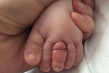 Bé sơ sinh suýt mất ngón chân vì một sợi tóc của mẹ