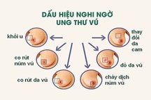 Ung thư vú: Phát hiện sớm bệnh có thể điều trị khỏi