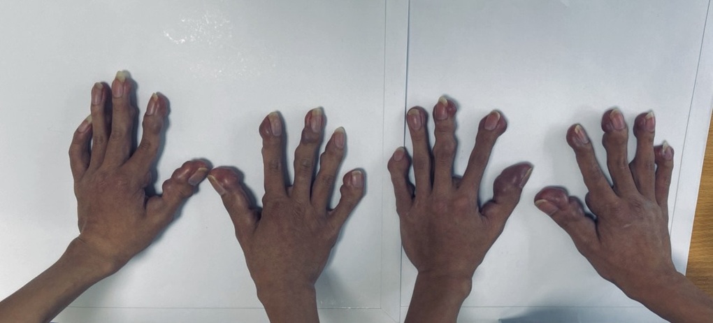 Hai anh em sinh đôi người củi với hàng trăm khối u trên cơ thể - 3 Hai anh em sinh đôi người củi với hàng trăm khối u trên cơ thể - 3
