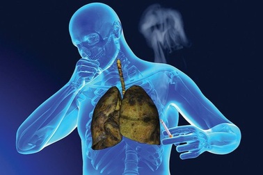 Tiên lượng điều trị ung thư phổi như thế nào?