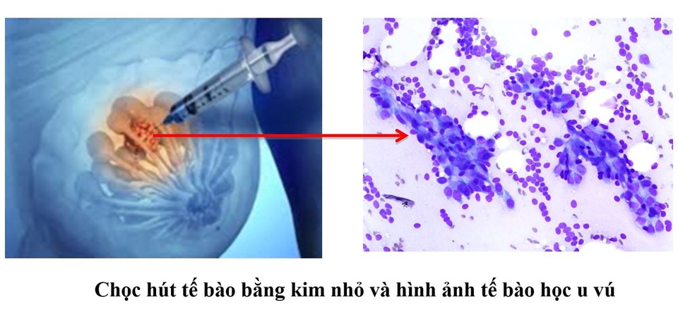 Sinh thiết vú là gì? - 1 Sinh thiết vú là gì? - 1