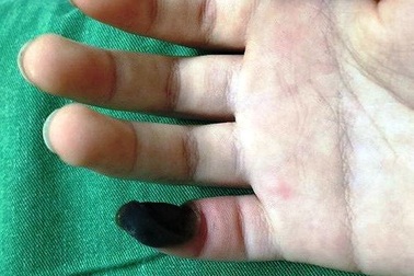 Mua thuốc trên mạng để trị mụn cóc, bé 6 tuổi bị hoại tử ngón tay