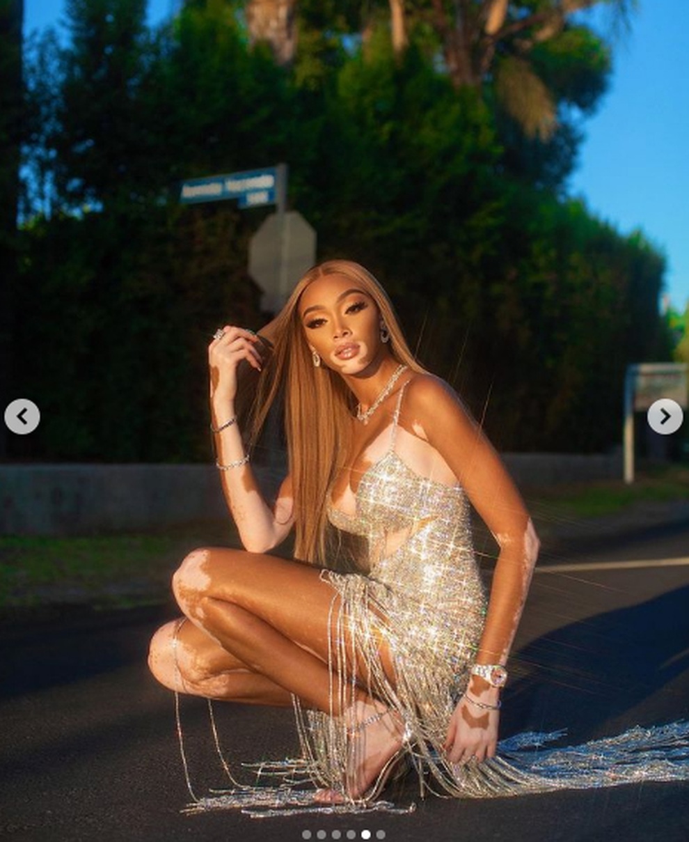 Siêu mẫu bạch biến Winnie Harlow mặc váy hở bạo đón tuổi 27 - 2 Siêu mẫu bạch biến Winnie Harlow mặc váy hở bạo đón tuổi 27 - 2