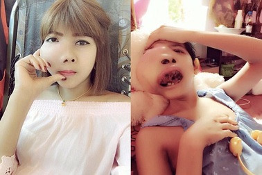 Tưởng đau răng hóa ung thư hàm