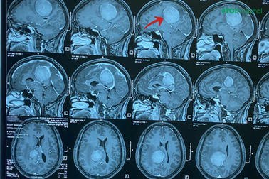 "Phớt lờ" đau đầu, mất ngủ, tê bì chân tay, nguy cơ hệ lụy khó lường