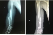 Chơi vật tay với bạn, thanh niên 19 tuổi bị gãy xương cánh tay