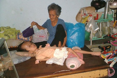 Bà cụ mong sống thêm 2 năm để nuôi cháu đầu to