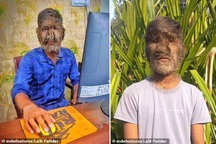 Ấn Độ: Nghị lực sống và tinh thần lạc quan của chàng trai "người sói"