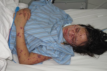 Phát hiện ca viêm não mô cầu đầu tiên ở miền Bắc