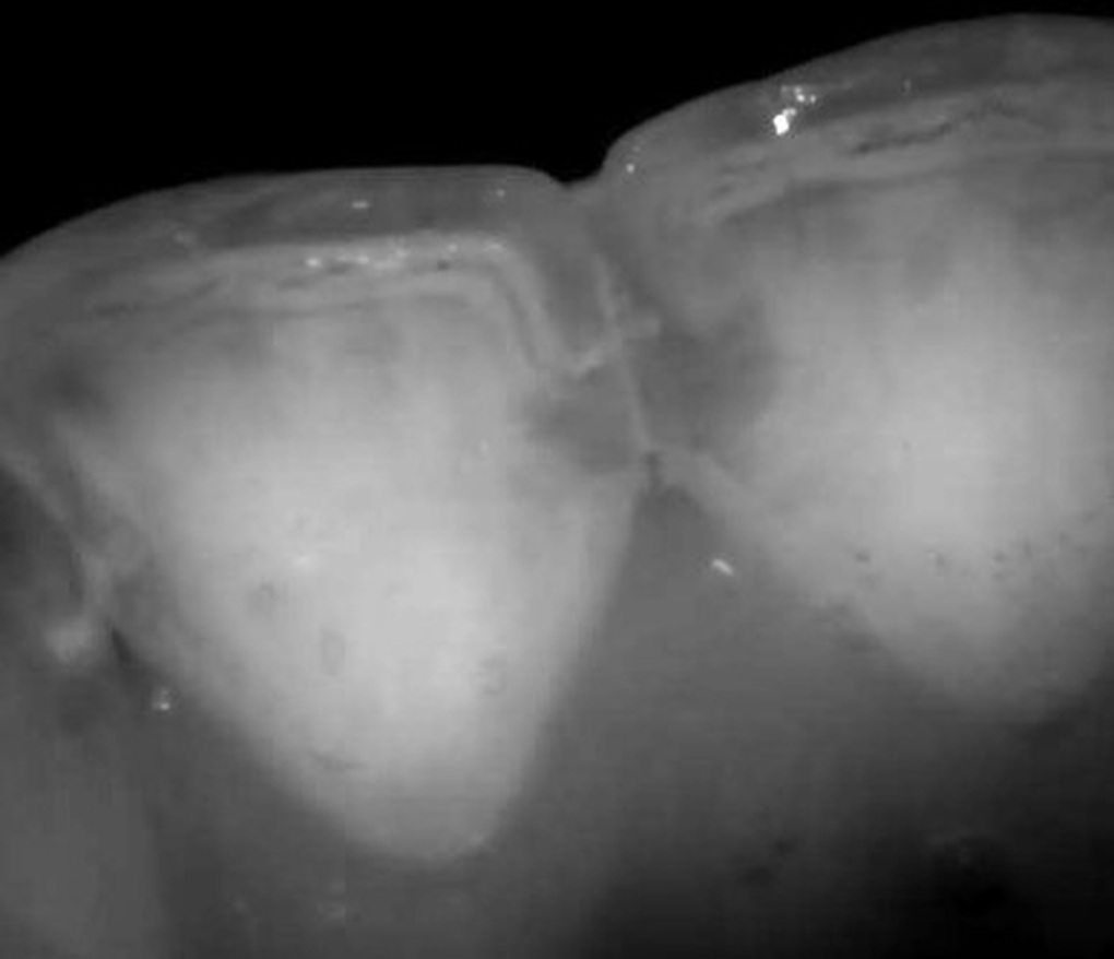 Ánh sáng cận hồng ngoại - phương pháp phát hiện sớm sâu răng mặt bên - 4 Ánh sáng cận hồng ngoại - phương pháp phát hiện sớm sâu răng mặt bên - 4