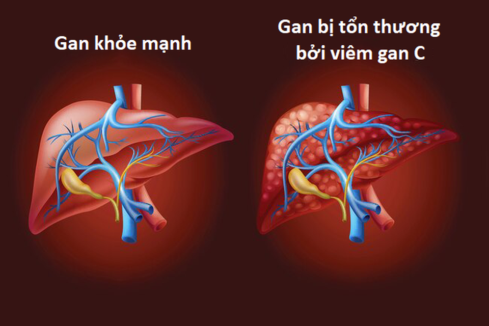 Những thói quen xấu khiến viêm gan nhanh chóng tiến triển thành xơ gan - 3 Những thói quen xấu khiến viêm gan nhanh chóng tiến triển thành xơ gan - 3