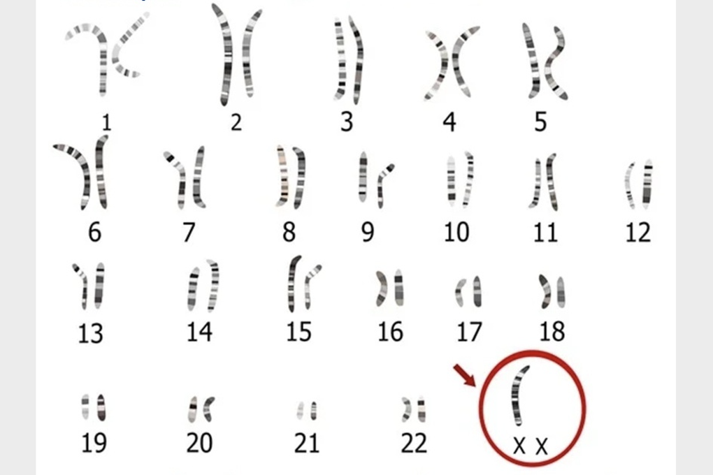 Märkligt nog har den 24-åriga flickan ännu inte nått puberteten på grund av ett slumpmässigt kroppsfel - 1 Kỳ lạ, cô gái 24 tuổi vẫn chưa dậy thì vì lỗi ngẫu nhiên của cơ thể - 1