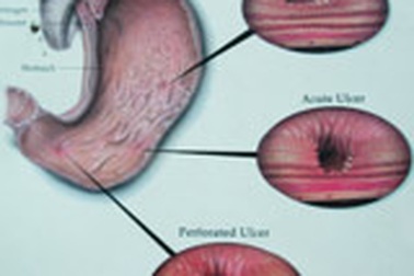 Tâm lý bất ổn: nguy cơ gây viêm dạ dày 