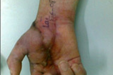 Nối thành công 2 ca đứt lìa nửa bàn tay