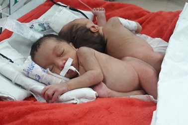 Hai bé song sinh dính liền mông, không thấy hậu môn