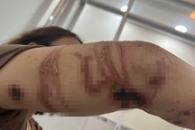 Nhiều người bị sứa nguy hiểm "tấn công" khi tắm biển Vũng Tàu, Phan Thiết