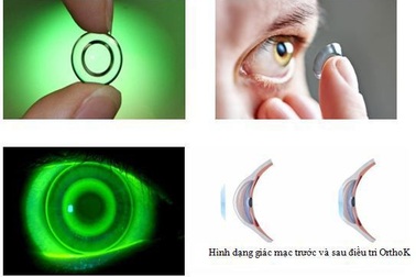 Điều chỉnh cận loạn thị không phẫu thuật bằng phương pháp Ortho K
