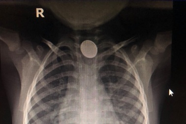 Bé trai bị hóa chất ăn mòn thực quản vì nuốt cục pin
