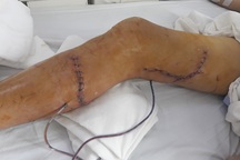 Bác sĩ về tận địa phương cứu bệnh nhân bị máy cắt nát chân