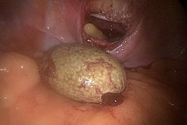 Viên sỏi như quả trứng gà trong bàng quang cậu bé 13 tuổi