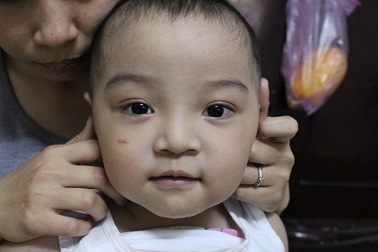 Bé trai 31 tháng tuổi chênh vênh sự sống vì bệnh tim bẩm sinh phức tạp