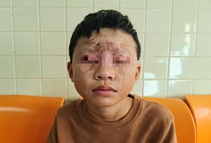 Trẻ bị thương do tự chế pháo nổ theo youtube.