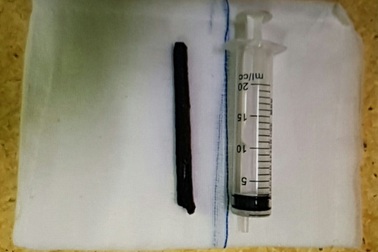 Cành cây đâm xuyên mắt lên não vì ngã xe đạp