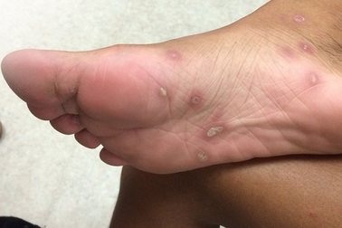 Gia tăng người mắc sùi mào gà, giang mai vào bệnh viện cầu cứu