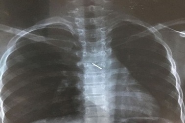 Đinh ghim sắt chui tọt vào phế quản bé gái 12 tuổi