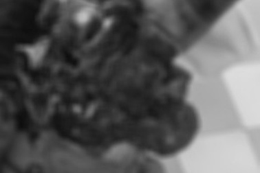 Cậu bé lớp 9 phải cắt cụt bàn tay nát bét do mày mò chế thuốc nổ làm pháo