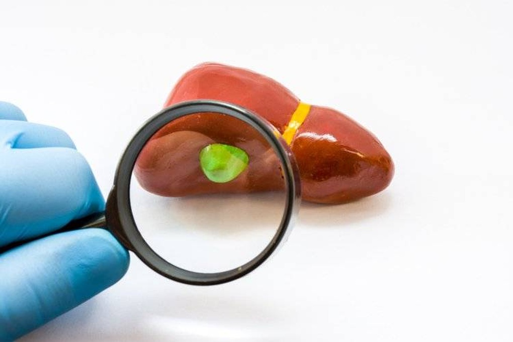 Phát hiện polyp túi mật liệu có nguy cơ tiến triển thành ung thư? - 1 Phát hiện polyp túi mật liệu có nguy cơ tiến triển thành ung thư? - 1