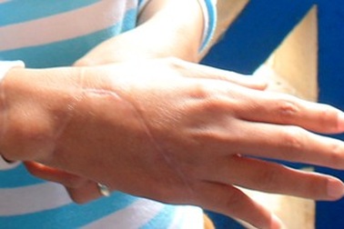 Vụ chặt tay, cướp SH: Chị Thúy mong lành vết thương để nuôi con